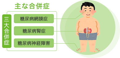 主な合併症 三大合併症 糖尿病網膜症 糖尿病賢症 糖尿病神経障害